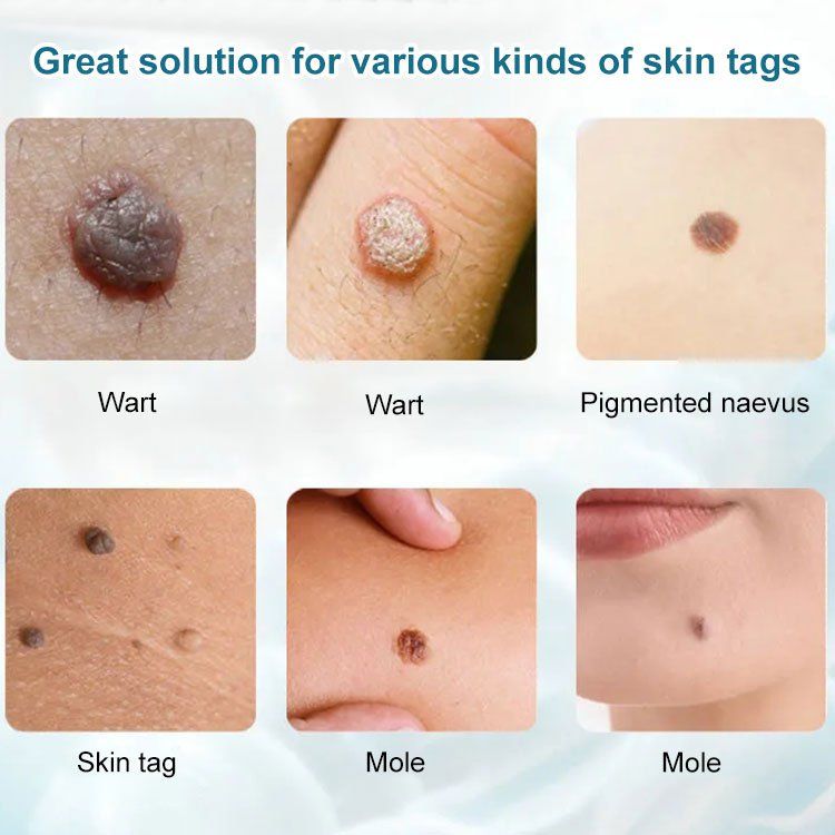 （🔥LAST DAY SALE-80% OFF) HZA™ Concentrated potent skin tag removal cream